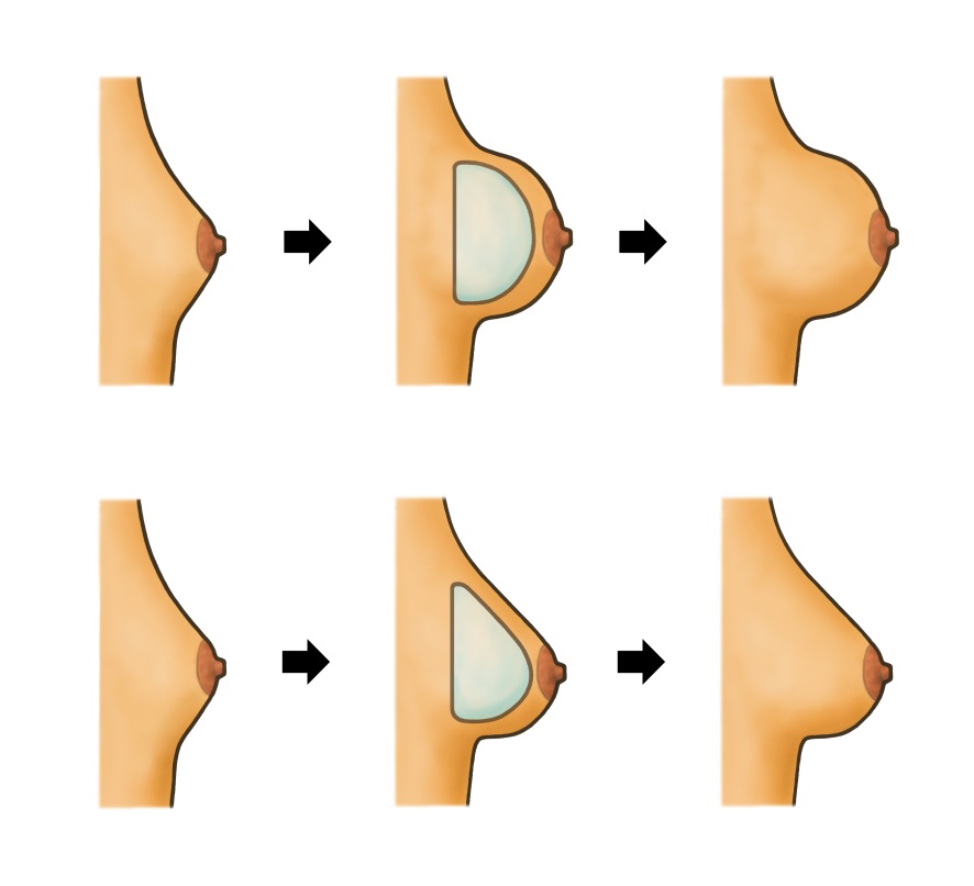 Breast enlargement